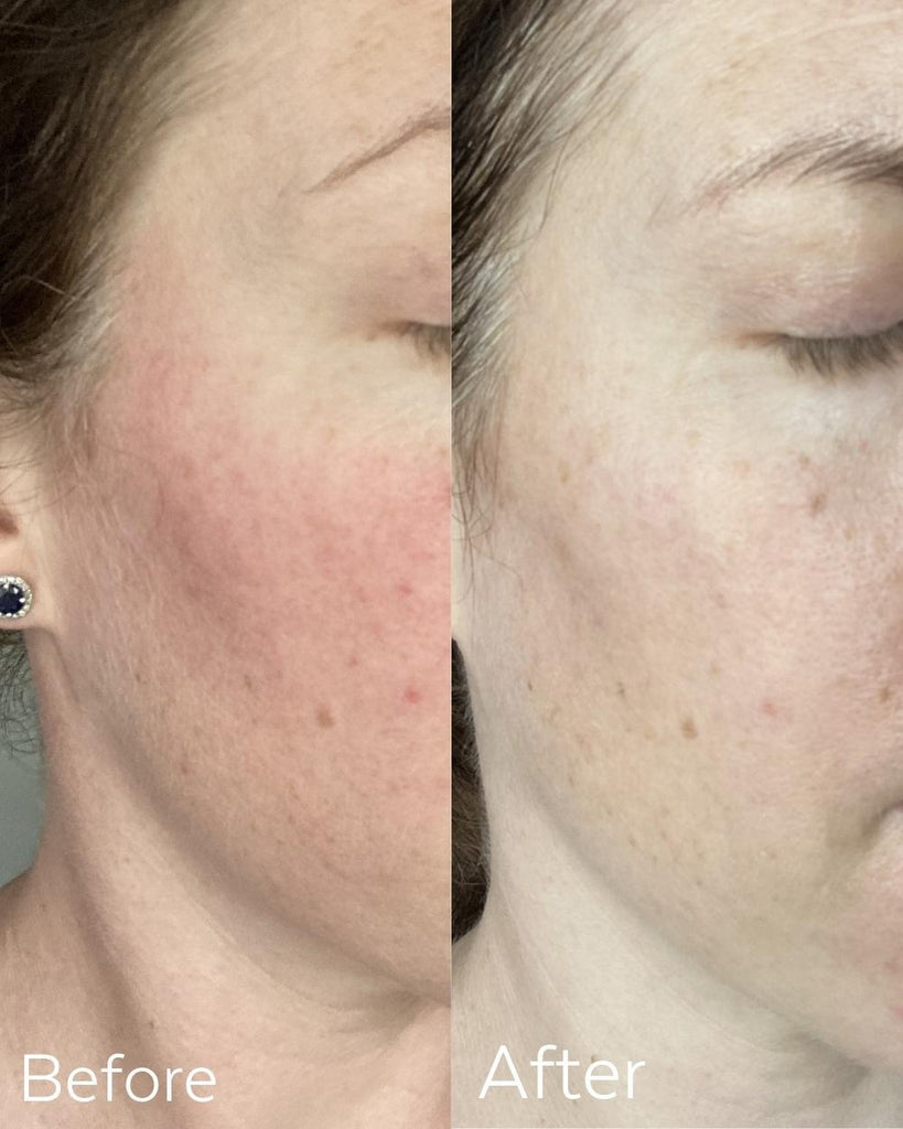 Before and After images of a person's skin after using Three Ships Calm Lavender Hydrosol Toner